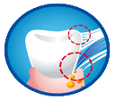 超極細毛が歯周ポケットの奥深くまで入り込み、歯周病の原因のひとつである歯垢や汚れを逃さず除去します。